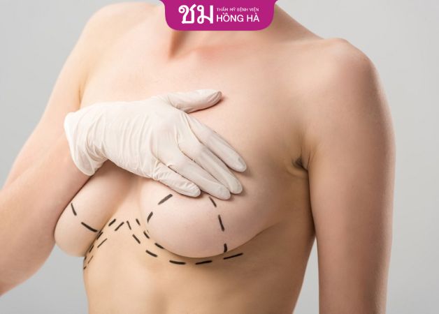 Treo ngực sa trễ có sẹo không