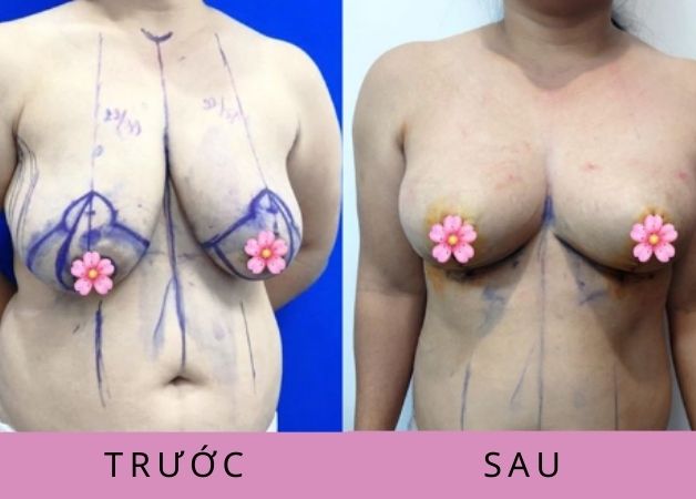 Sở hữu bầu ngực căng tròn và tạm biệt chảy xệ