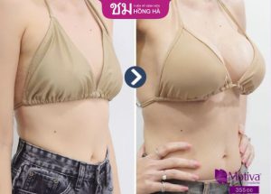 Nâng ngực đẹp tự nhiên: Bí quyết sở hữu vòng 1 hoàn mỹ