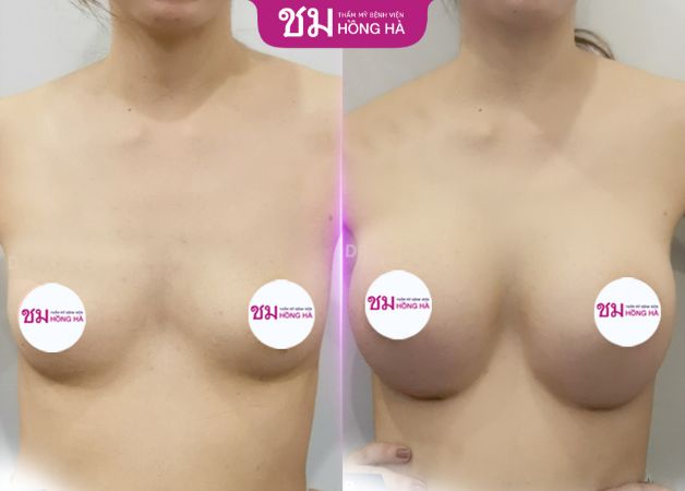 Kết quả trước sau của khách hàng khi nâng ngực tại Hồng Hà