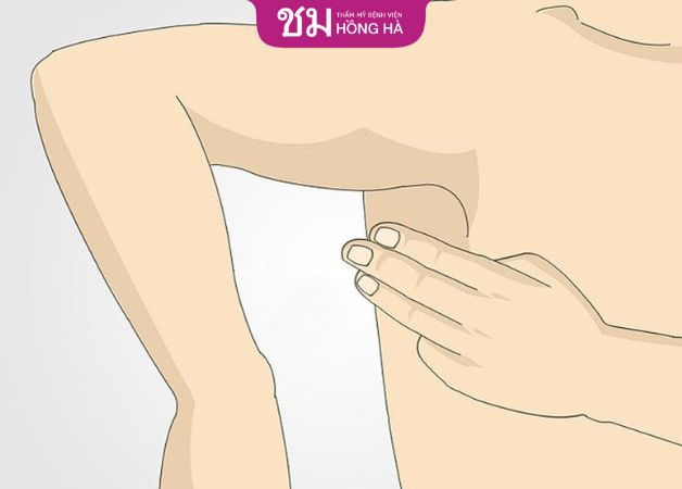 Tuyến vú phụ ở nách có nên cắt không
