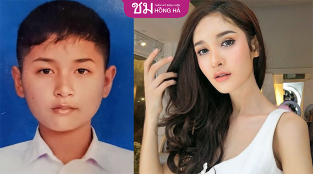 Phẫu thuật chuyển giới từ nam sang nữ trải qua nhiều bước