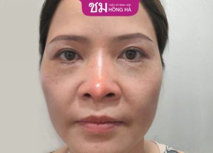 7 Ngày sau nâng mũi vẫn sưng do đâu? Cách khắc phục hiệu quả