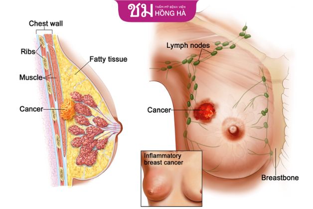 Nịt ngực quá lâu tăng khả năng gây ung thư vú