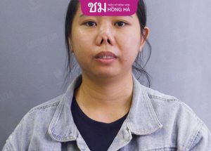 Những biến chứng nâng mũi sụn tai – Cách phòng ngừa hiệu quả