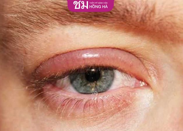 Mí mắt sưng đau nếu chăm sóc sai cách