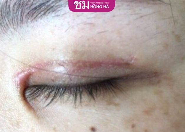 Mí mắt lên sẹo sau khi cắt mí