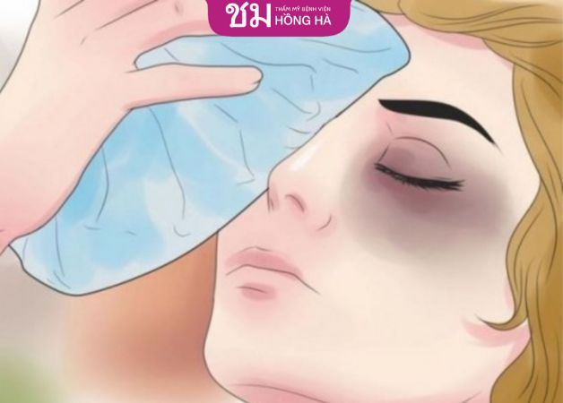 Chườm lạnh và chườm ấm sau khi cắt mí