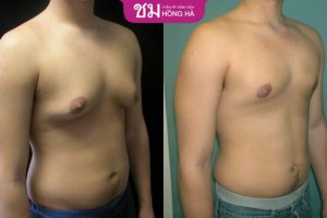 Cách làm nhỏ ngực ở nam giới như thế nào? Cách nào hiệu quả nhất