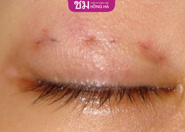 Cắt mí mắt sau 5 - 7 ngày hết sưng bầm