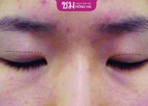 6 Cách trị thâm mắt sau cắt mí hiệu quả