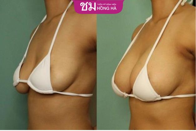 Cắt da ngực bị chảy xệ ở mức độ trung bình