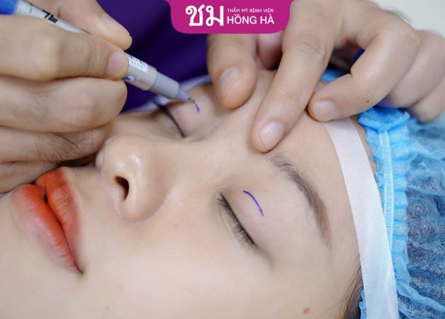 Thời gian phun mí sau cắt mí bao lâu phụ thuộc vào kỹ thuật thực hiện của bác sĩ thẩm mỹ