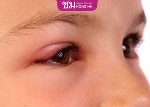 Cắt mí bị sưng 1 bên phải làm sao – Cách giảm sưng sau cắt mí