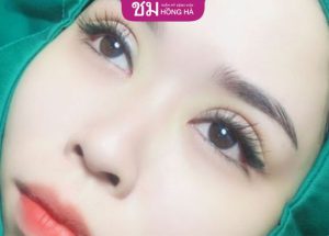 Hỏi đáp cùng chuyên gia: Cắt mí có làm mắt to hơn không?