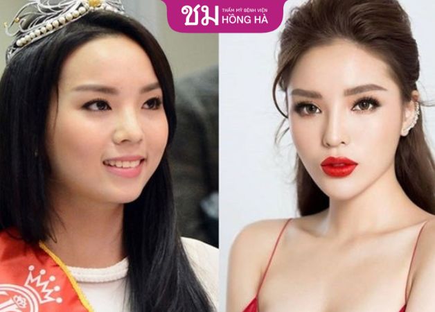 Thần thái Kỳ Duyên sang chảnh hơn hẳn sau cắt mí