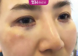 Cắt mí dưới bao lâu hết sẹo – Cách xử lý sẹo hiệu quả