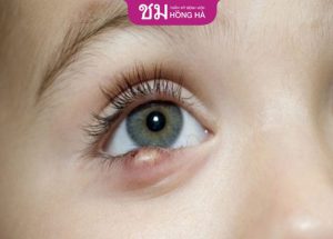 Cắt mí dưới bị nổi cục – Nguyên nhân, cách chăm sóc
