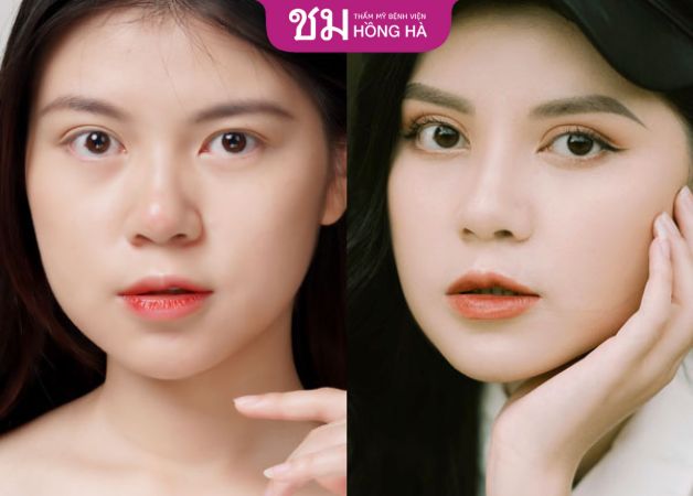Khách hàng sở hữu đôi mắt to tròn long lanh