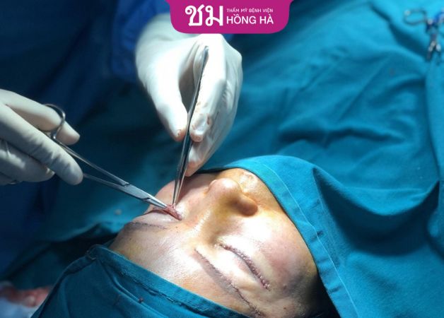 Cắt mí dưới nổi cục do dụng cụ y tế chưa được vô trùng kỹ lưỡng