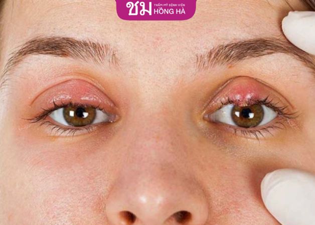 Nhiễm trùng sau cắt mí vô cùng nguy hiểm