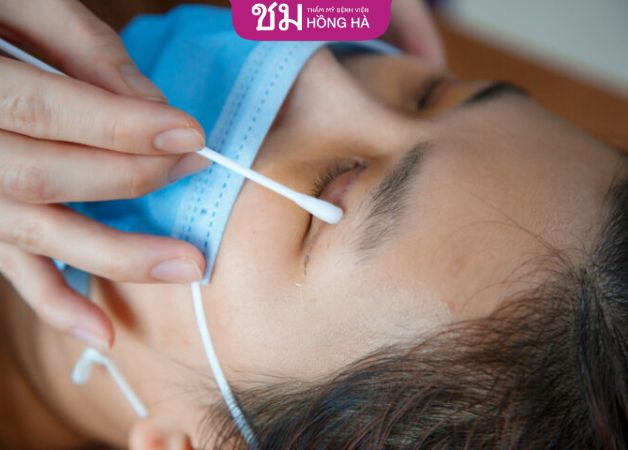 Vệ sinh mí mắt bằng nước muối sinh lý
