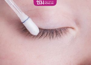 Cắt mí mắt có bị sẹo lồi không? Tip xử lý sẹo sau khi cắt mí mắt