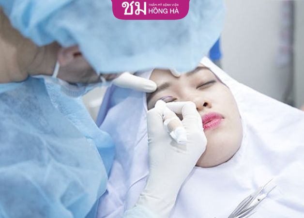 Do bác sĩ thực hiện cắt mí không chuẩn khiến mí mắt bị sưng