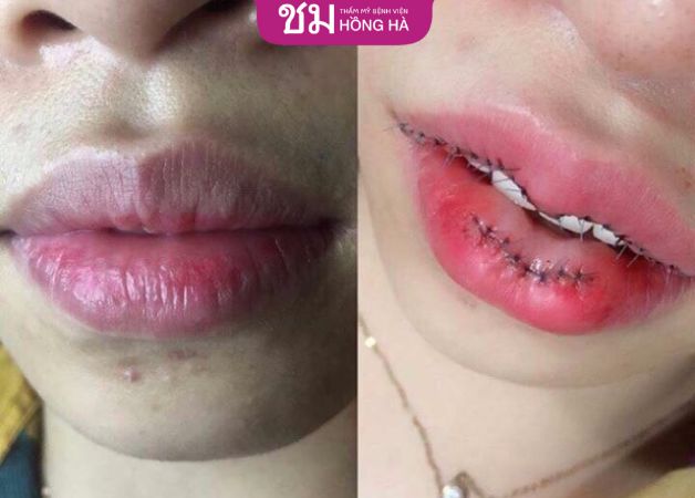 Cắt môi trái tim bao lâu thì lành