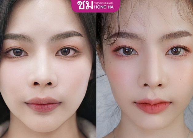Hình ảnh trước sau khi cắt môi tim của khách hàng