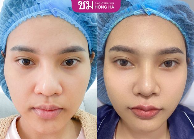 Môi dày, không rõ viền môi tim được khắc phục hoàn hảo sau khi thực hiện tạo hình môi