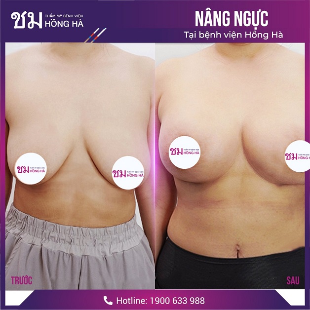 Sau khi cắt chỉ phẫu thuật da ngực chảy xệ người bệnh có thể tắm rửa