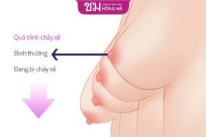 Cắt ngực sa trễ- Phương pháp thu gọn sa trễ hiệu quả