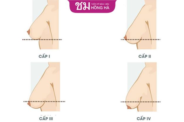 Có nhiều cấp độ ngực sa trễ và phương pháp phẫu thuật khác nhau