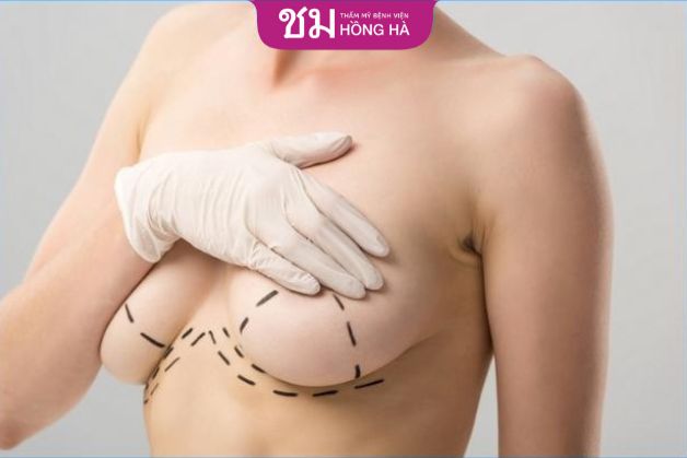 Phẫu thuật cắt ngực chay xệ được tiến hành giúp loại bỏ da thừa