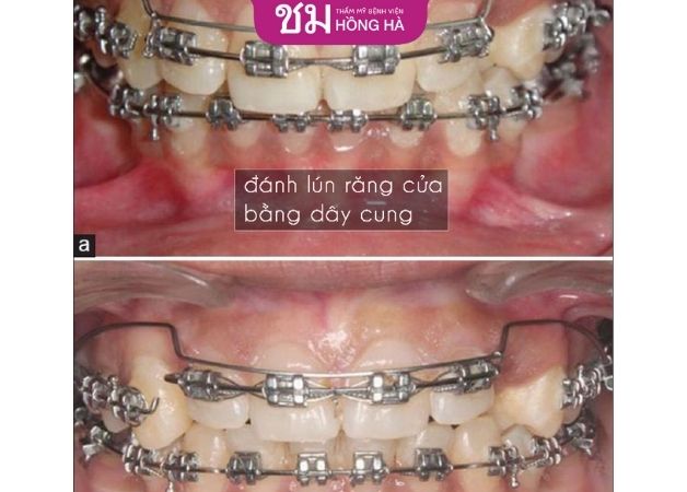 Khách hàng cười hở lợi đã được khắc phục bằng phương pháp đánh lún răng