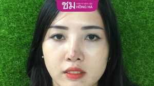 7 dấu hiệu nâng mũi không hợp sụn – Cách khắc phục