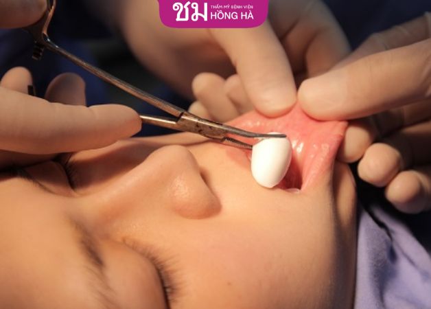 Độn cằm bằng chất liệu sụn nhân tạo lành sau 2 - 4 tuần