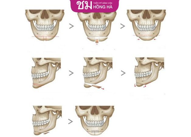 Phẫu thuật trượt cằm đẹp tự nhiên sau 1 - 3 tháng