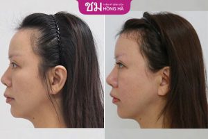 Gọt trán nữ hóa hết bao nhiêu? quy trình thực hiện như thế nào?