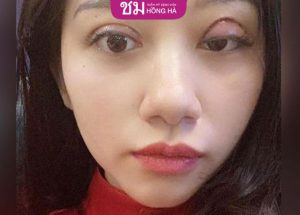 5 Hiện tượng sau khi cắt mí mắt và Cách phòng tránh