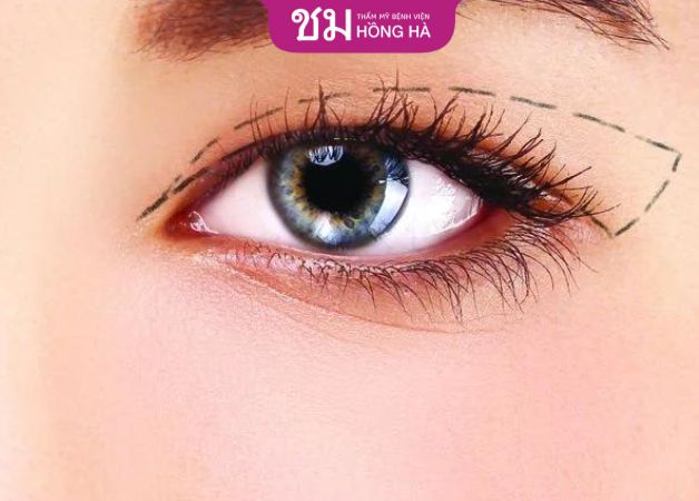 Thường thì cắt mí sau 1 tuần vết thương đã lành
