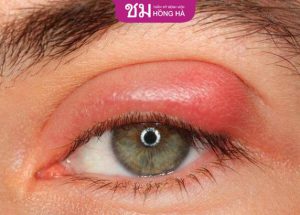 Mắt bị sưng sau khi cắt mí – 5 Cách giảm sưng nhanh chóng