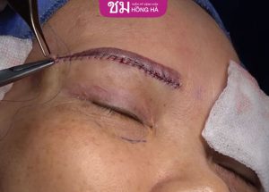 Hỏi đáp: Nâng cung chân mày có để lại sẹo không?