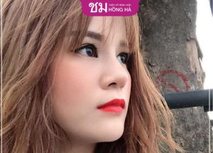 Giải đáp ngay: Nâng mũi bằng sụn tai có bị teo lại không