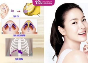 Nâng mũi bằng sụn tự thân có tốt không? bác sĩ hồng hà giải đáp