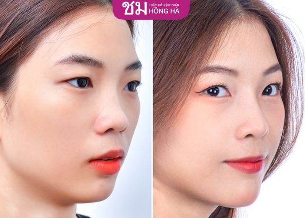 Nâng mũi sụn tự thân có thể giữ được 15 - 20 năm