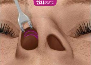 Nâng mũi cấu trúc kín: Ưu nhược điểm – 4 lưu ý sau khi nâng mũi