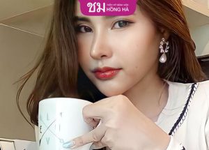 Nâng mũi cấu trúc sau 1 tháng: Mũi hết sưng, vào form tự nhiên