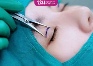 Nhấn mí sau này có bị sụp mí không? – Giải đáp từ chuyên gia
